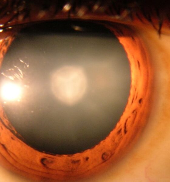 Cataract Surgeryy