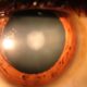 Cataract Surgeryy